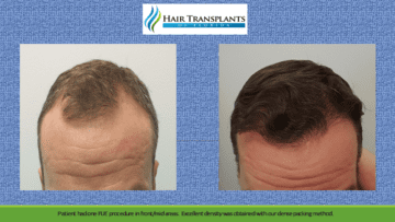 Hair Restoration Before After Photos