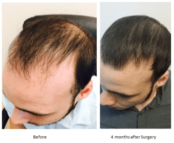 tampa hair transplants before after photos