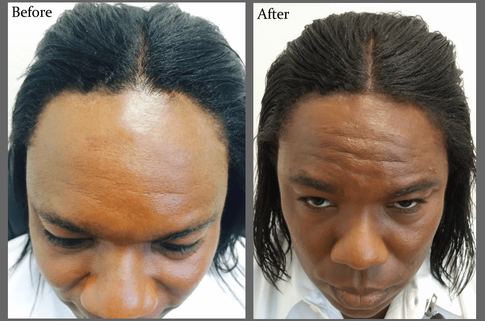Solutions for men's hair loss | Hair restoration in Florida