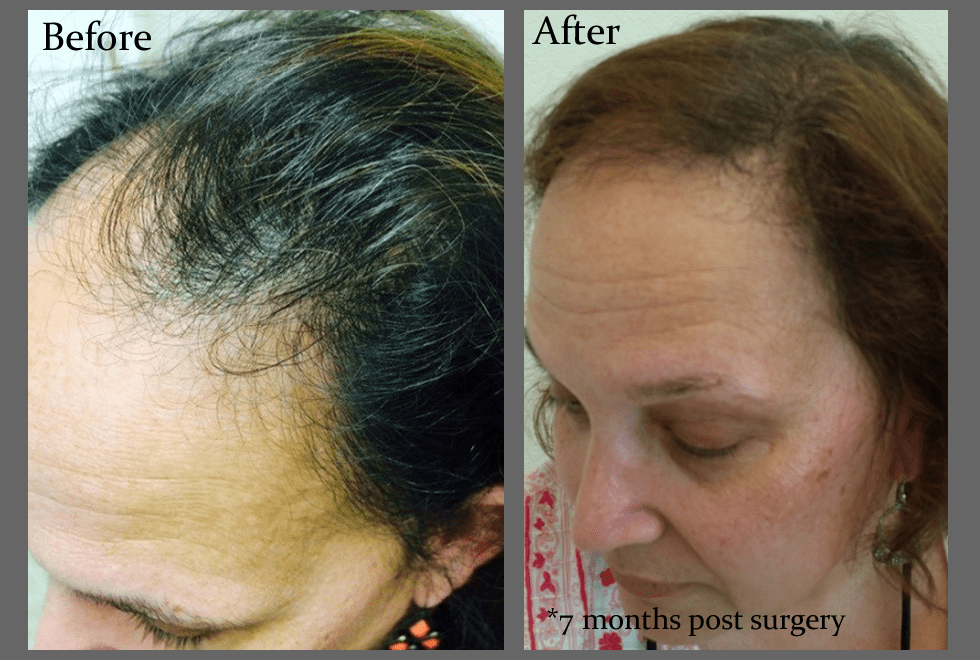 Women's Hair Loss and Hair Restoration for Women