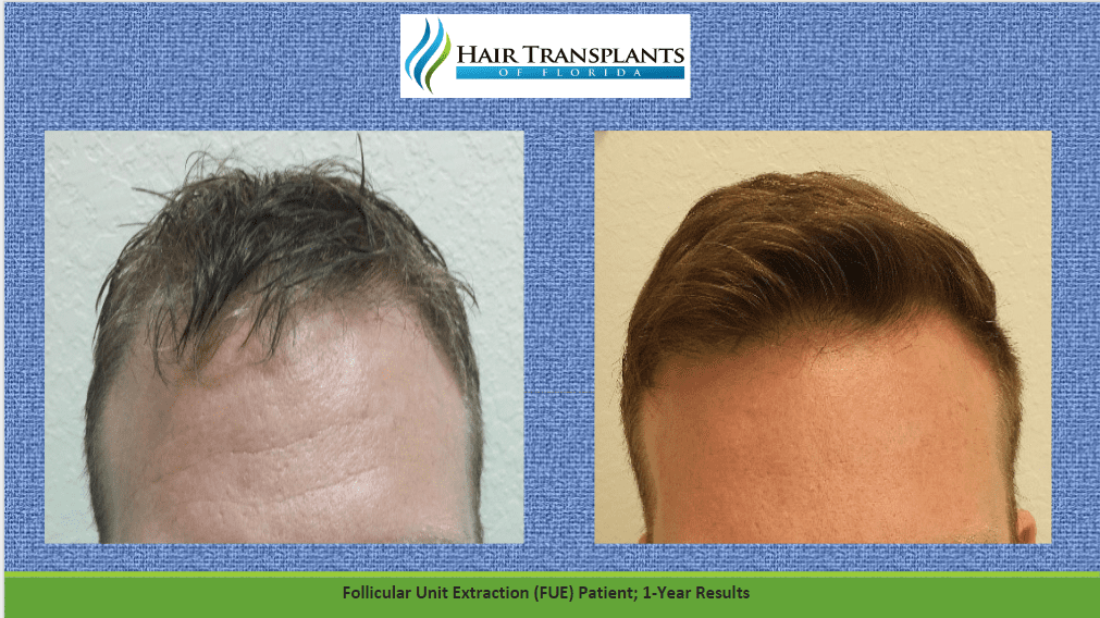 North Carolina Hair Transplant Options - Save 30% at Hair Transplants of FL